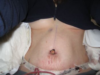 belly button piercing after tummy tuck